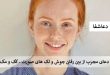 جوش2-110x75 دعای مجرب از بین رفتن جوش و لک های صورت - کک و مک  