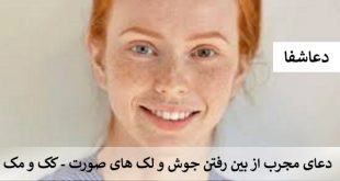 جوش2-310x165 دعای مجرب از بین رفتن جوش و لک های صورت - کک و مک  